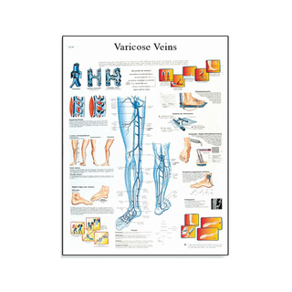 Varicose vein laminated poster