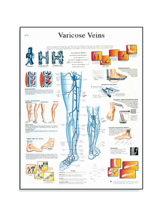 Varicose vein laminated poster
