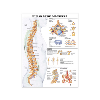 Disease of the spine poster English