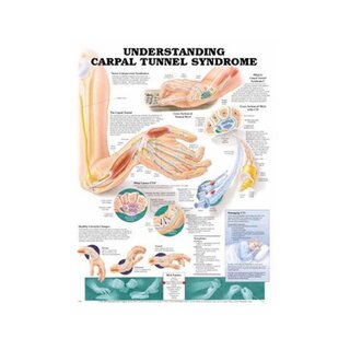 Plane carpal tunnel syndrome English
