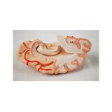 8-split brain with arteries in split head