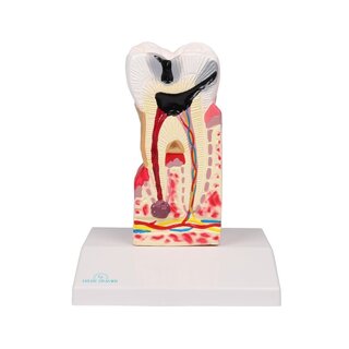 Dental caries model, 10 times life size