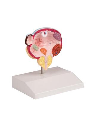 Diseases of the bladder and prostate