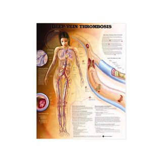 Deep vein thrombosis (DVT) - planch
