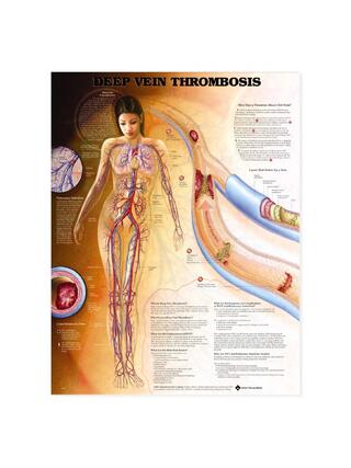 Deep vein thrombosis (DVT) - planch