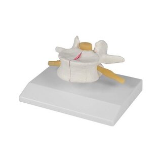 Osteoporosis vertebra, 2 times natural size