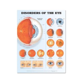 Eye Disorders Laminated Poster (Disorders of the Eye)