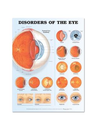 Eye Disorders Laminated Poster (Disorders of the Eye)