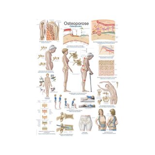 Poster Osteoporosis, Anatomical Poster 50x70cm