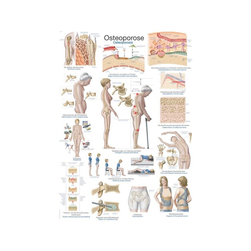 Poster Osteoporosis, Anatomical Poster 50x70cm