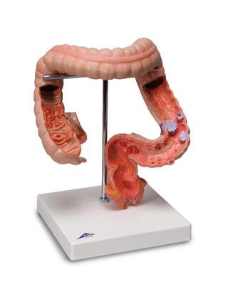 Detailed model of the large intestine showing several diseases