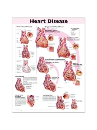 Laminated poster on heart disease in English