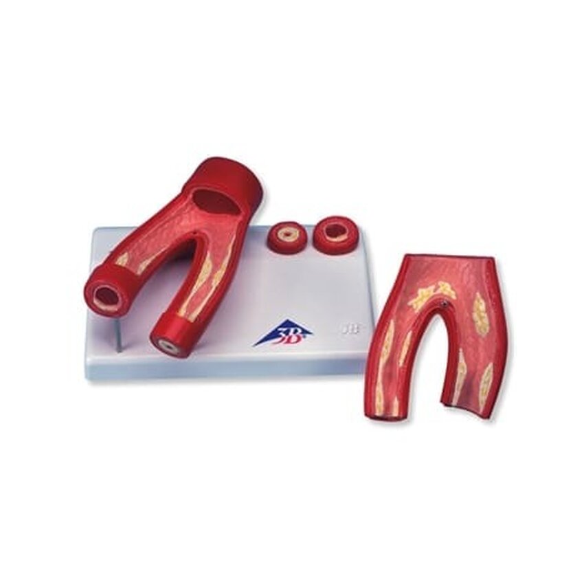 Atherosclerosis model with cross section of artery, two parts