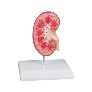 New model with kidney stones