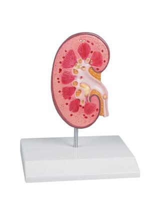 New model with kidney stones
