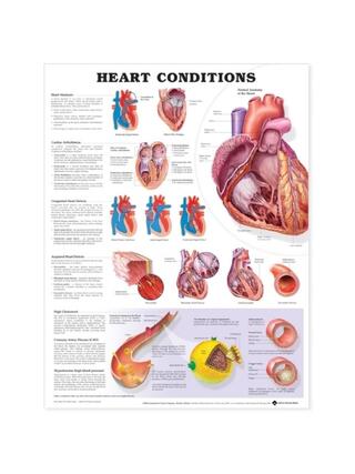 Heart disease laminated poster