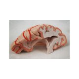 8-split brain with arteries in split head