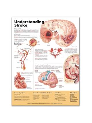 Understanding Stroke English Laminated (Understanding Stroke)