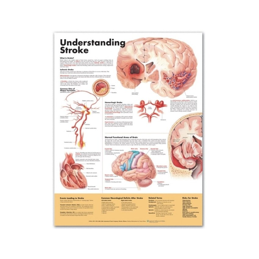 Understanding Stroke English Laminated (Understanding Stroke)