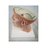 8-split brain with arteries in split head