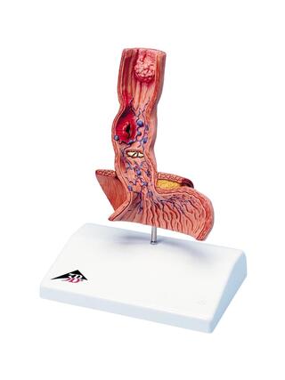 Model of the esophagus with pathological conditions