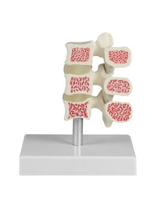 Osteoporosis vertebra model, 3 vertebrae