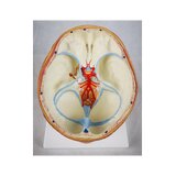 8-split brain with arteries in split head