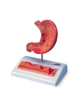 Mini model of the stomach with a stomach ulcer
