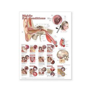 Diseases in middle ear laminated poster English